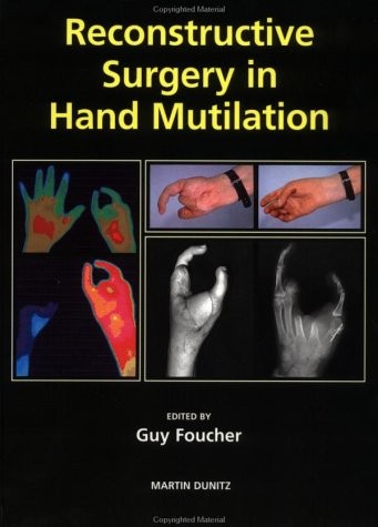 Reconstructive Surgery in Hand Mutilation