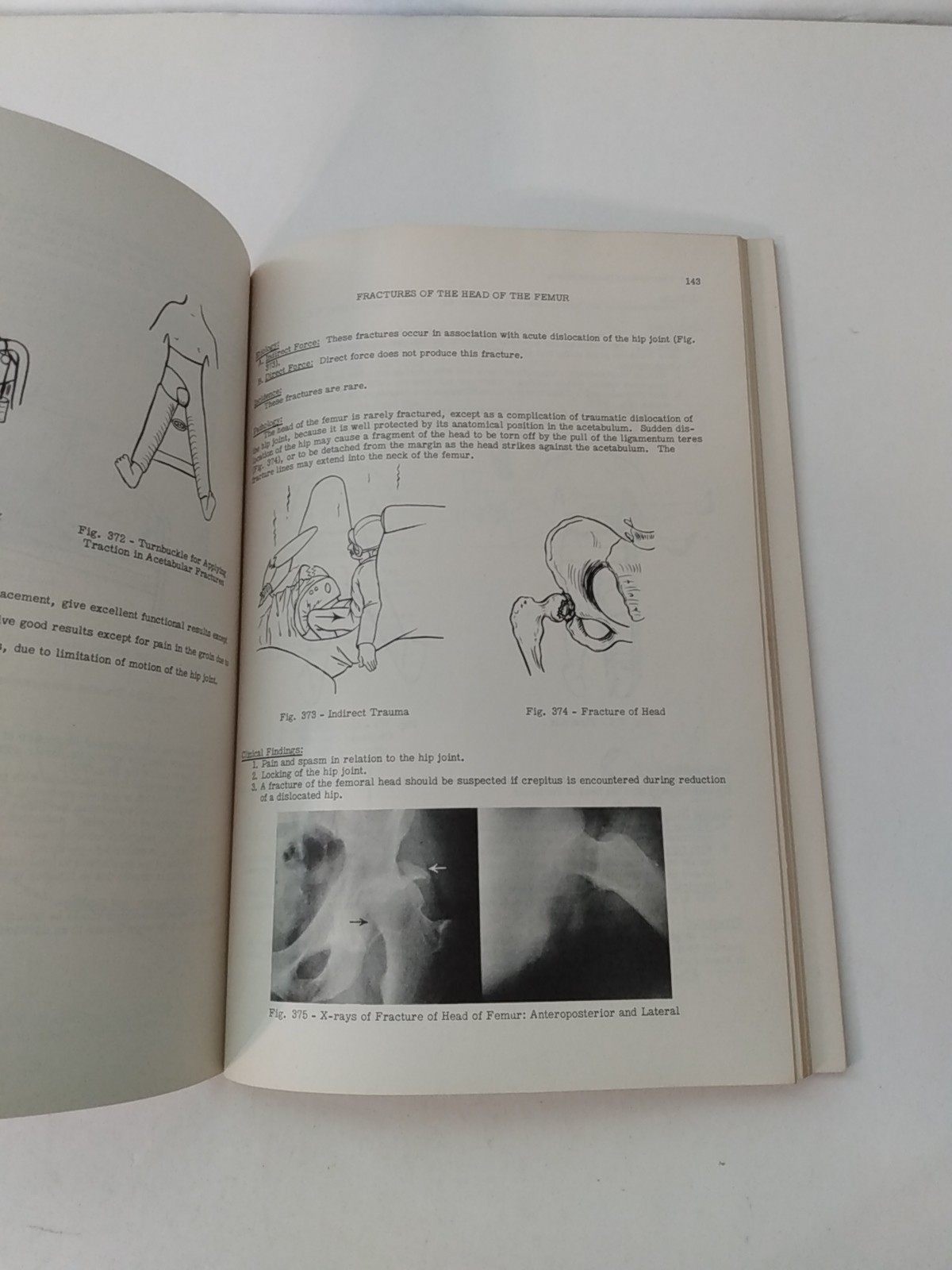 Illustrated Review of Fracture Treatment Frederick Liebolt VTG Medical Book 1954