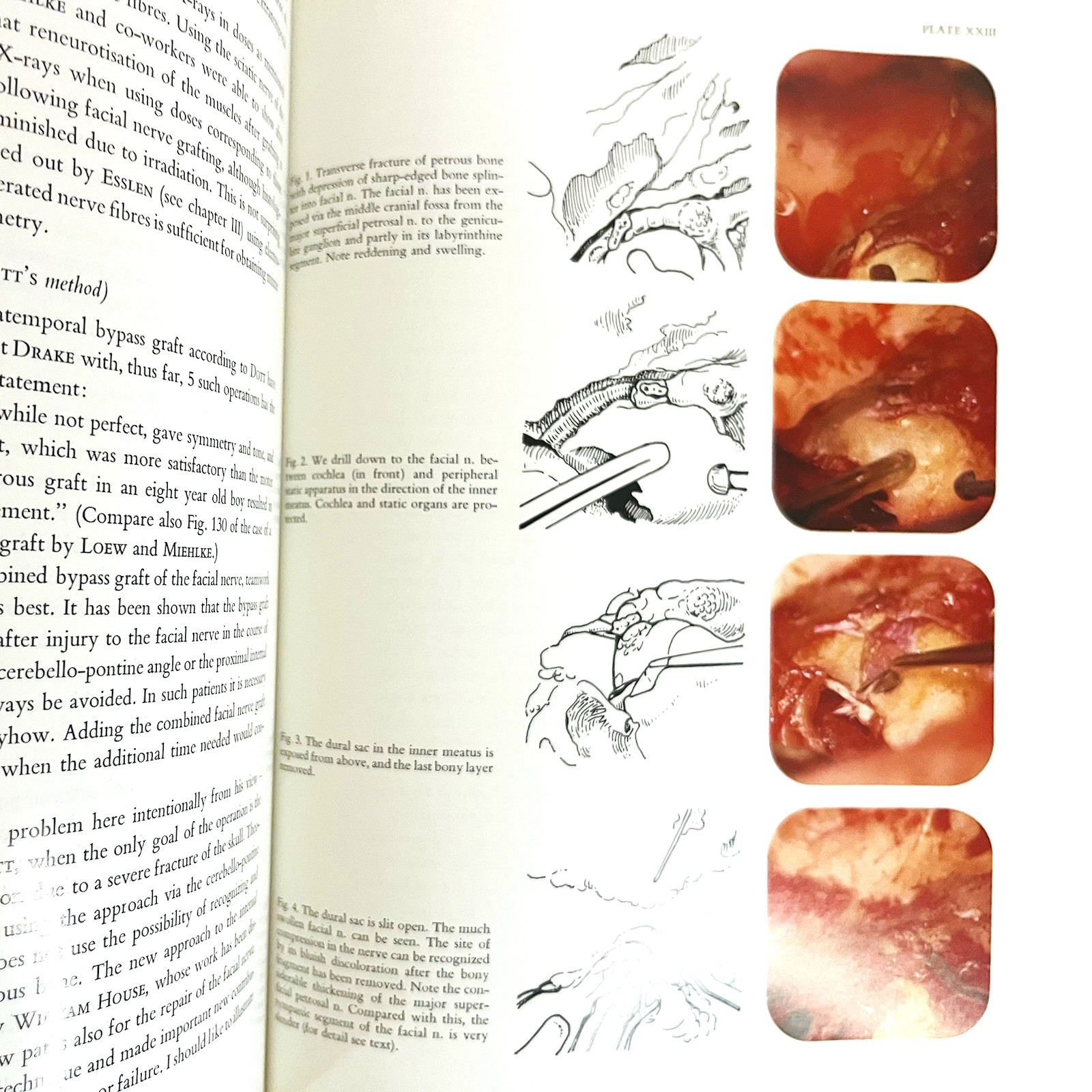 Vintage Surgery of The Facial Nerve Book Hardcover Adolf Michlke 1973